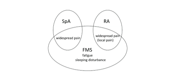 The disease concept of FMS, SpA , and RA: FMS, SpA, and RA are characterized by widespread pain, which often results in confusion. Note that FMS patients often possess a comorbidity with SpA or RA. 