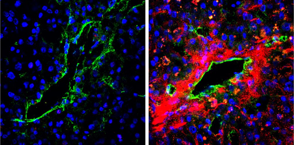 A strong biglycan signal (red) was detected in the tumour blood vessel area of a metastatic case (right) but was barely detected in the tumour tissues of a non-metastatic case (left). (Maishi N. et. al., Scientific Reports. June 13, 2016)