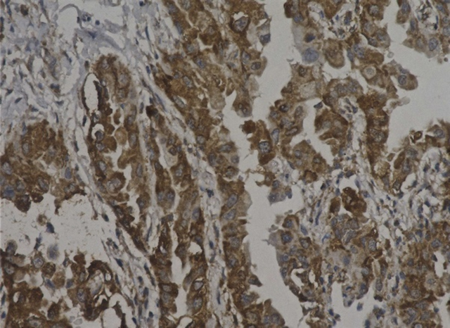 Expression of IL-34 (brown) in human primary lung adenocarcinoma tissue.