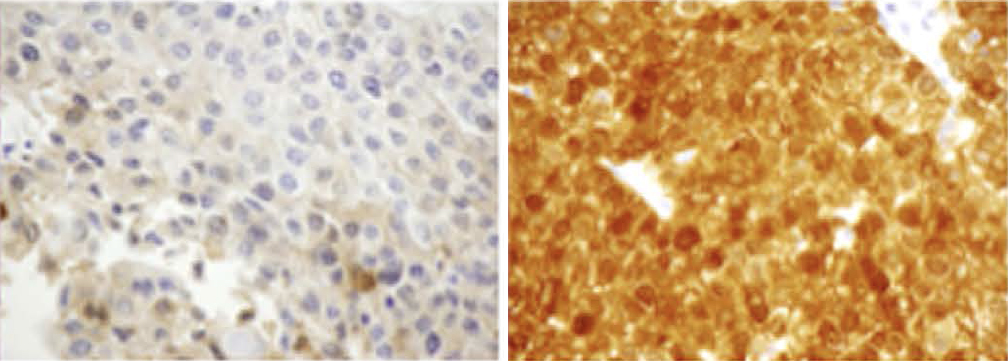 Expression of AKR1C1