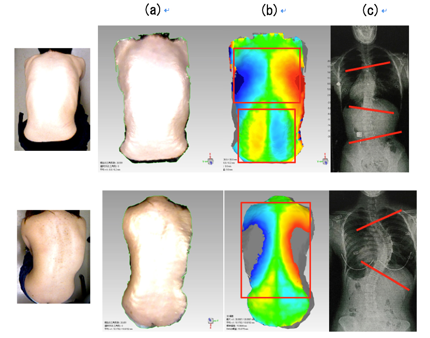 scoliosis detection