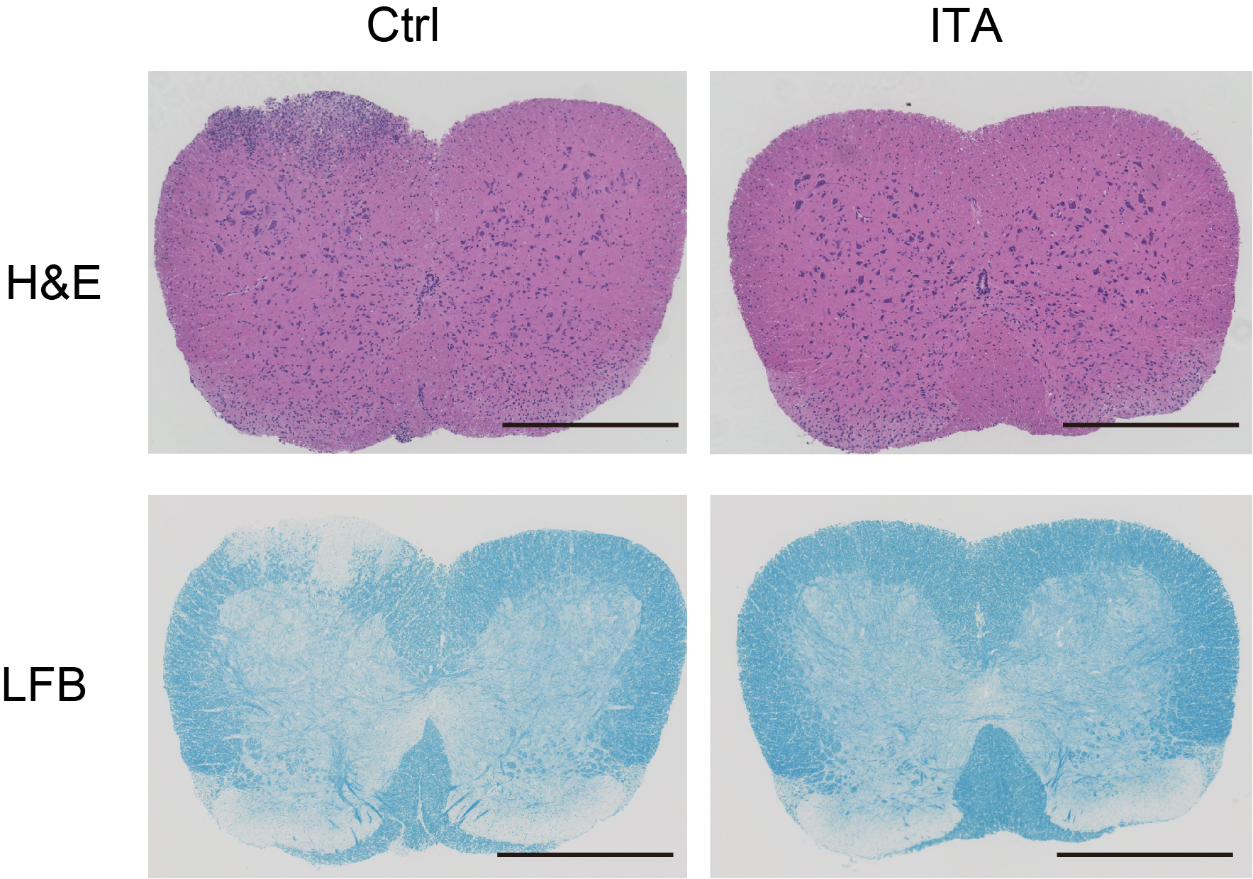 In mice models with adoptive transfer experimental autoimmune encephalomyelitis, treatment with itaconate (right) greatly ameliorates the effects of the disease, compared to untreated mice.